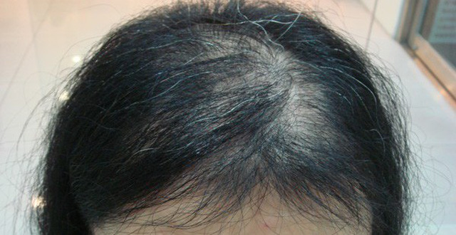 Rụng tóc là do đâu? Dầu gội ngăn rụng tóc tốt nhất hiện nay 2 dầu gội ngăn rụng tóc