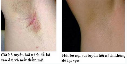 Lăn khử mùi tốt nhất hiện nay? Những sai lầm cần tránh 9 lăn khử mùi