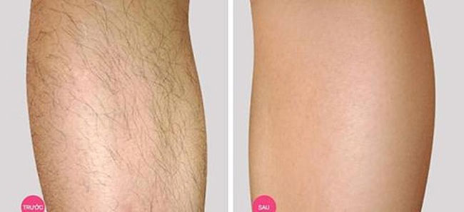 Triệt lông ở đâu vừa sạch vừa rẻ? TOP Spa triệt lông “sạch” tại Hà Nội 9 spa triệt lông