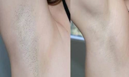 Triệt lông ở đâu vừa sạch vừa rẻ? TOP Spa triệt lông “sạch” tại Hà Nội 11 spa triệt lông