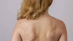 Xà phòng trị mụn lưng